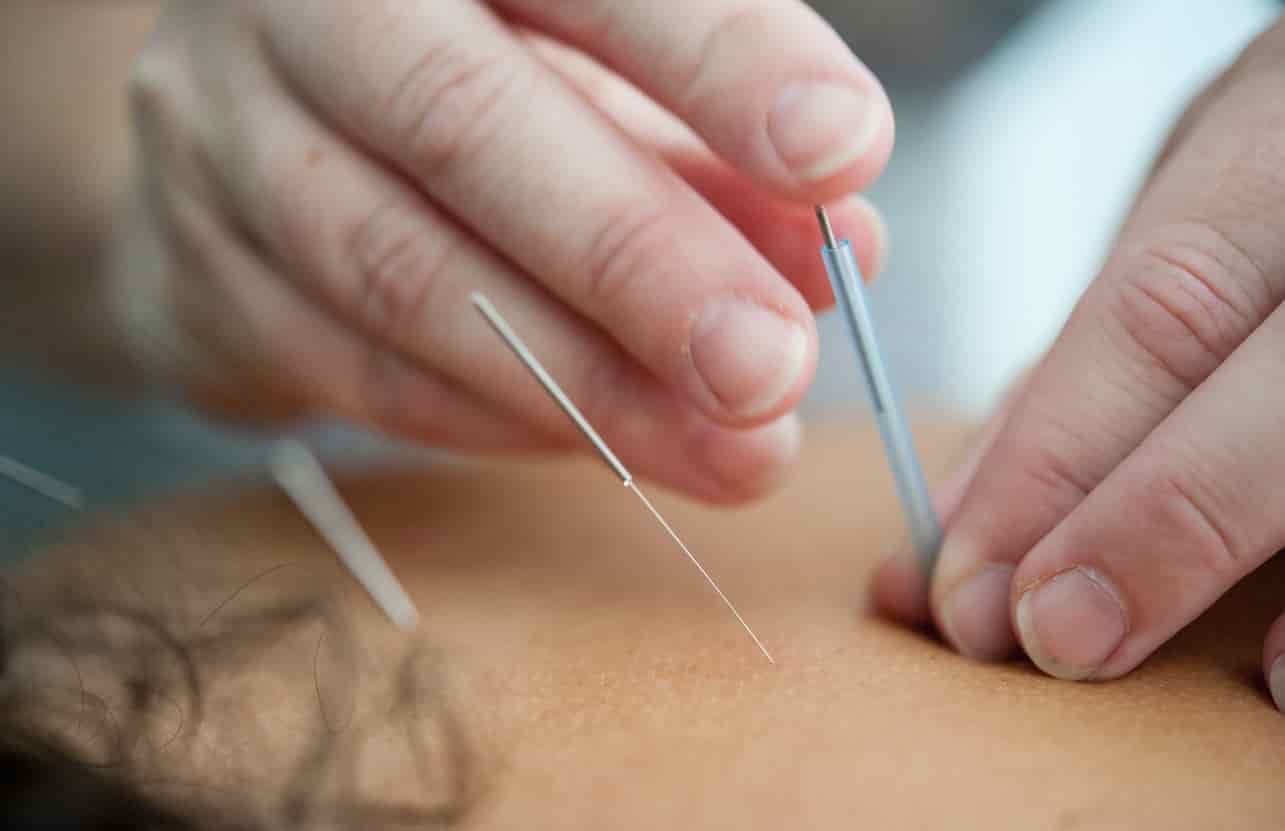 Akupunktur Ile Zayıflama Nasıl Gerçekleşir?