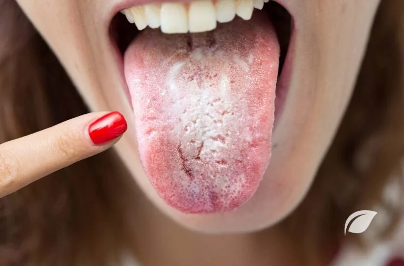 Candida Diyeti ve Candida Hastalarında Beslenme