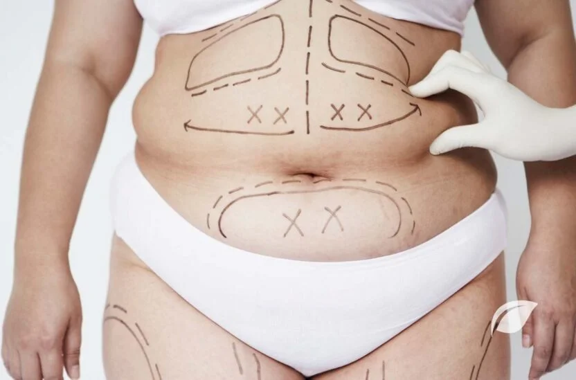 Liposuction ile Zayıflama