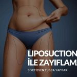 Liposuction Ile Zayıflama