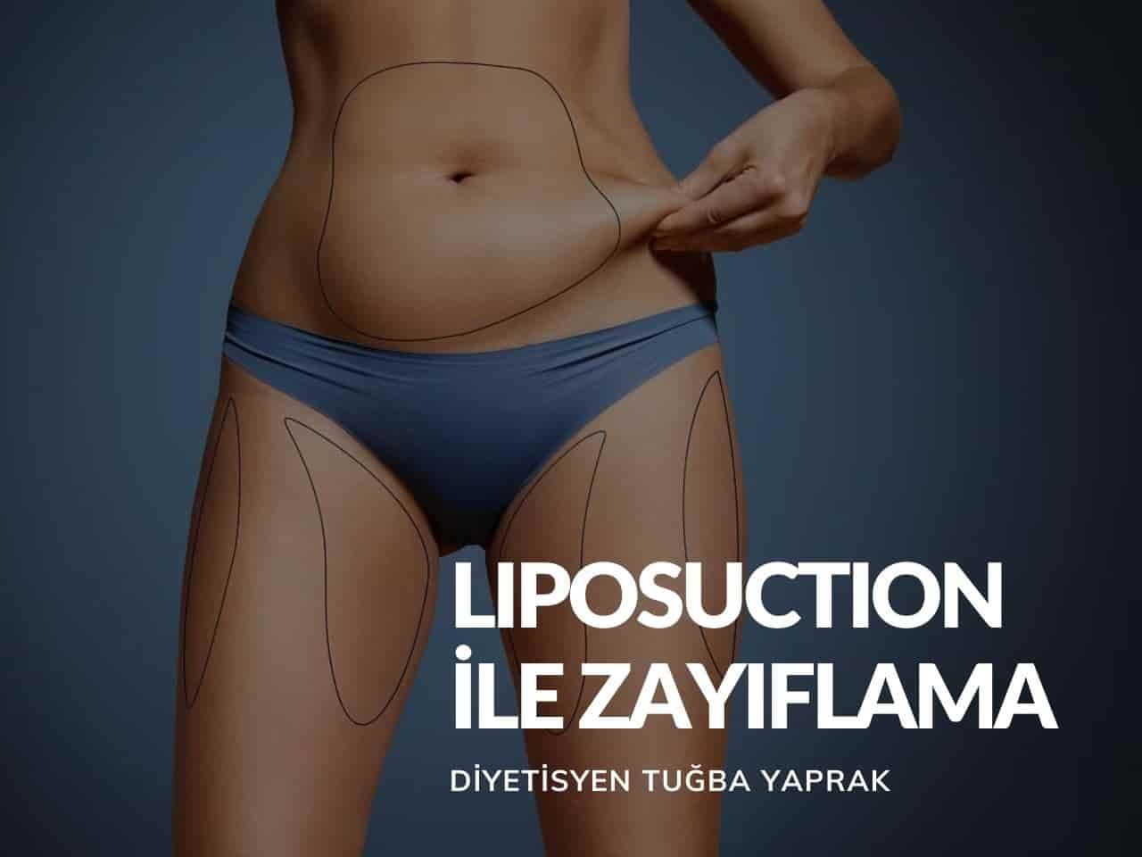 Liposuction Ile Zayıflama