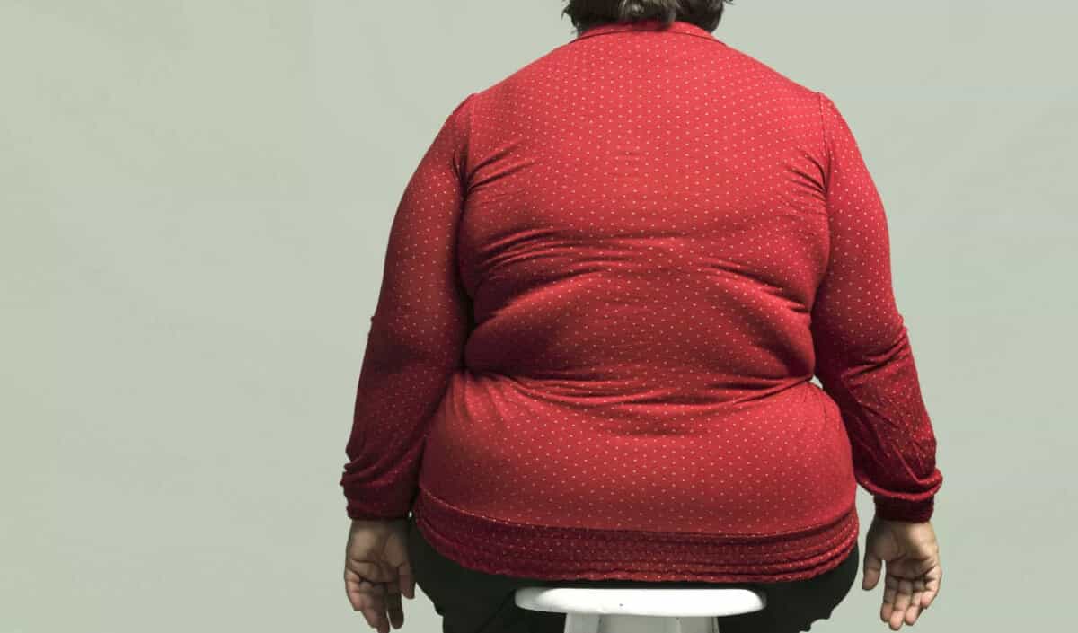 Obezite Tedavisi Nasıl Gerçekleşir?